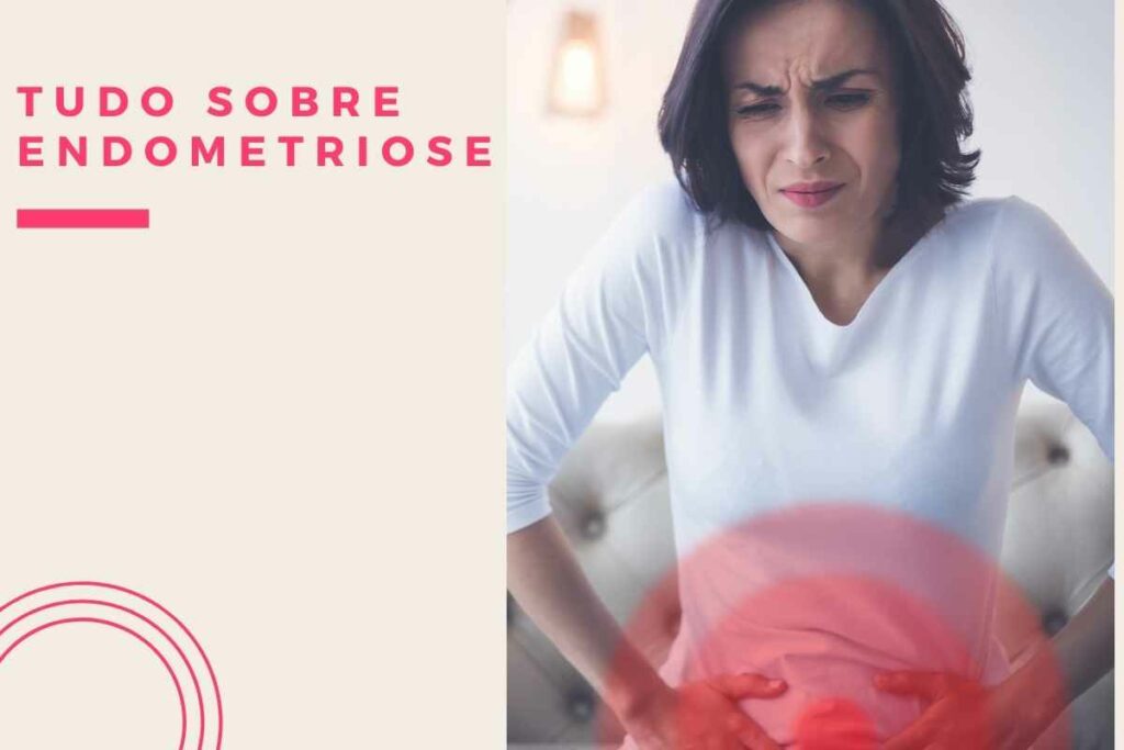 Tudo sobre endometriose (1)