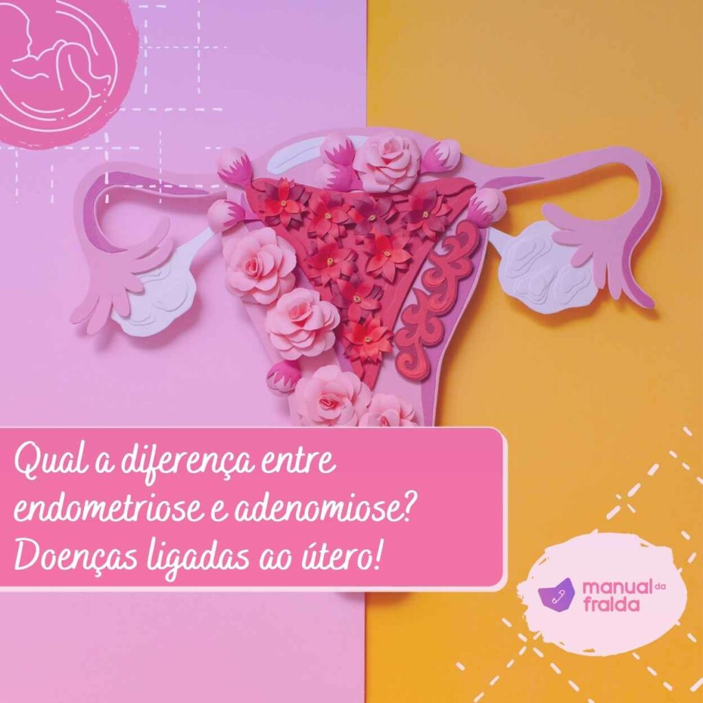 Qual a diferença entre endometriose e adenomiose Doenças ligadas ao útero!