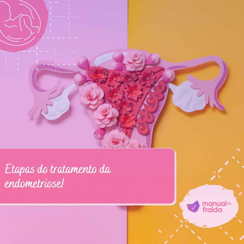 Etapas do tratamento da endometriose!