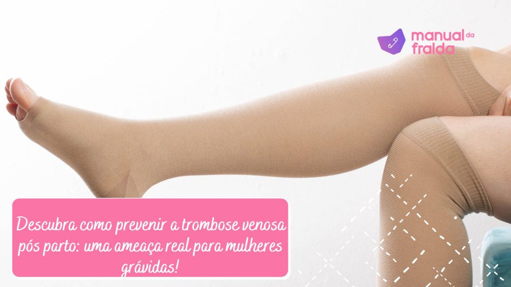Tudo sobre os cuidados com a trombose venosa na gestação e pós parto