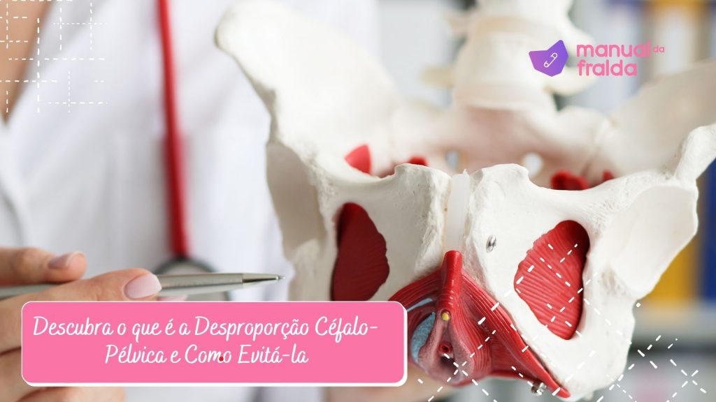 Descubra o que é a Desproporção Céfalo-Pélvica e Como Evitá-la